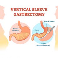 Gastric Sleeve Surgery Risks | Complications of Sleeve Gastrectomy