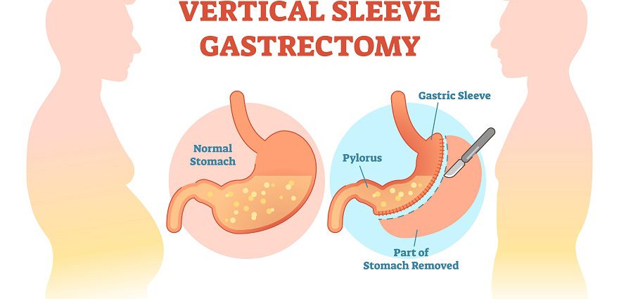 Gastric Sleeve Surgery | Is Vertical Sleeve Gastrectomy Right For You?